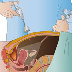 Neonatal Surgery