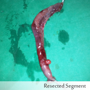 Resected Segment