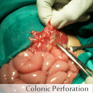 Colonic Perforation