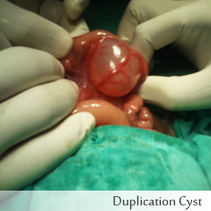 Duplication Cyst