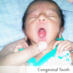 Congenital Tooth