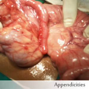 Appendicities