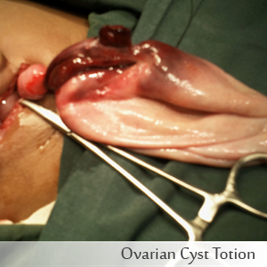 Ovarian Cyst Totion