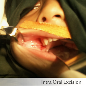 Intra Oral Excision
