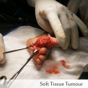 Soft Tissue Tumour