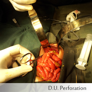 D.U. Perforation