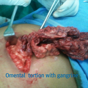Omental Tortion with Gangrine