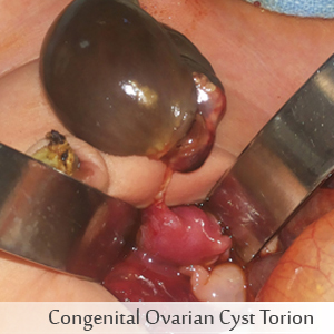 Congenital Ovarian Cyst Torion