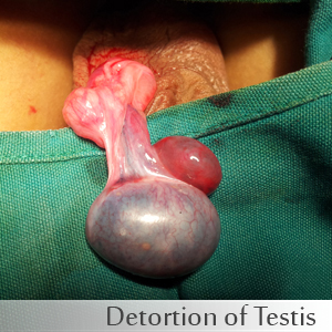 Detortion of Testis