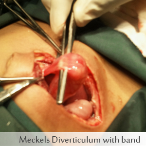 Meckels Diverticulum with band