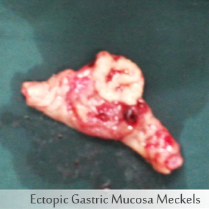 Ectopic Gastric Mucosa Meckels