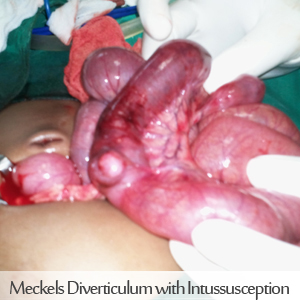 Meckels Diverticulum with Intussusception